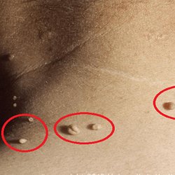 condylomes acuminés traitement naturel condylomes acuminés traitement naturel
